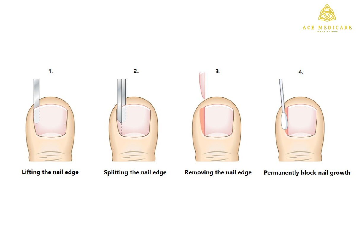 Understanding the Risks and Benefits of Nail Surgery